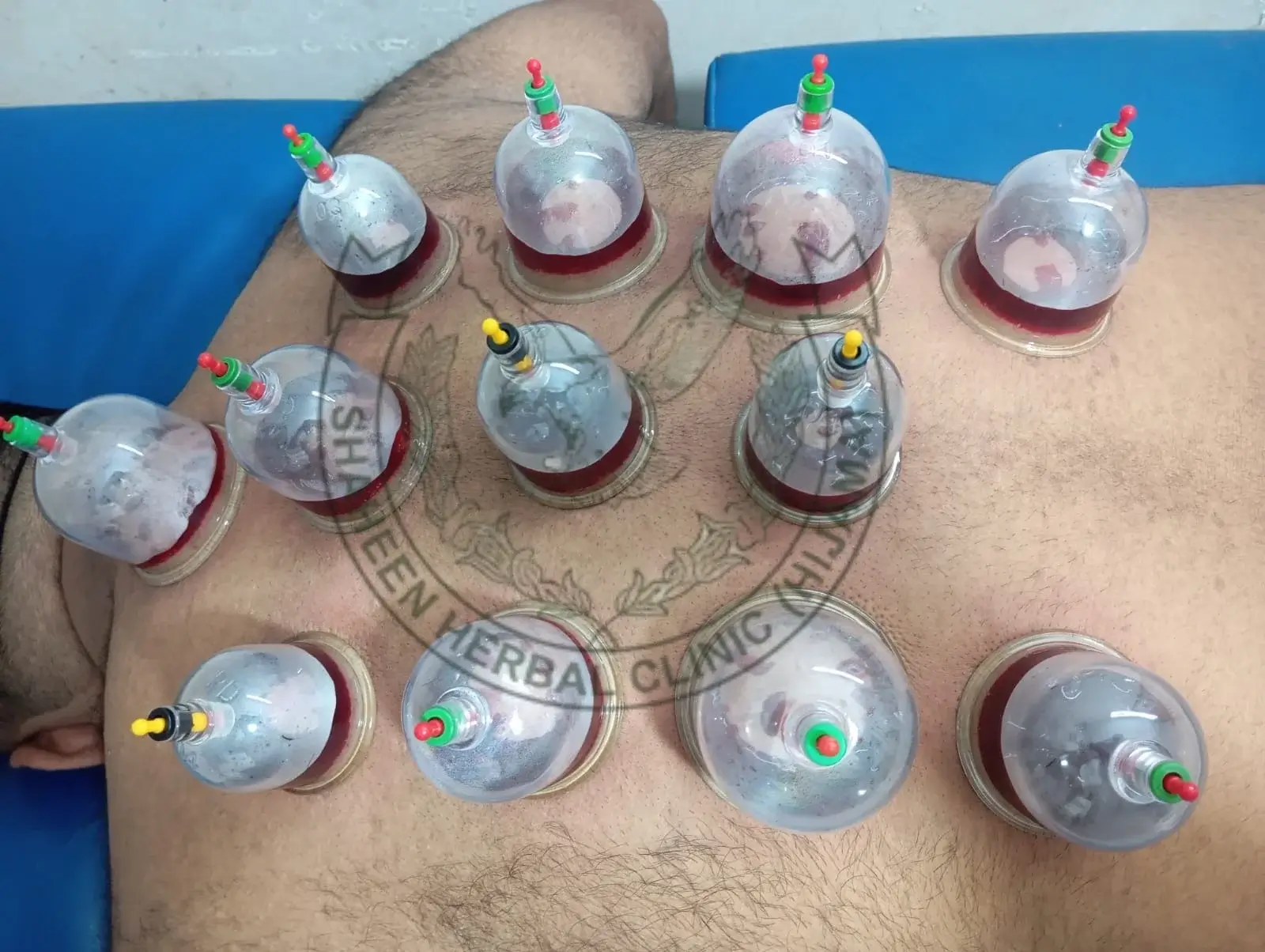 hijama for fat loss