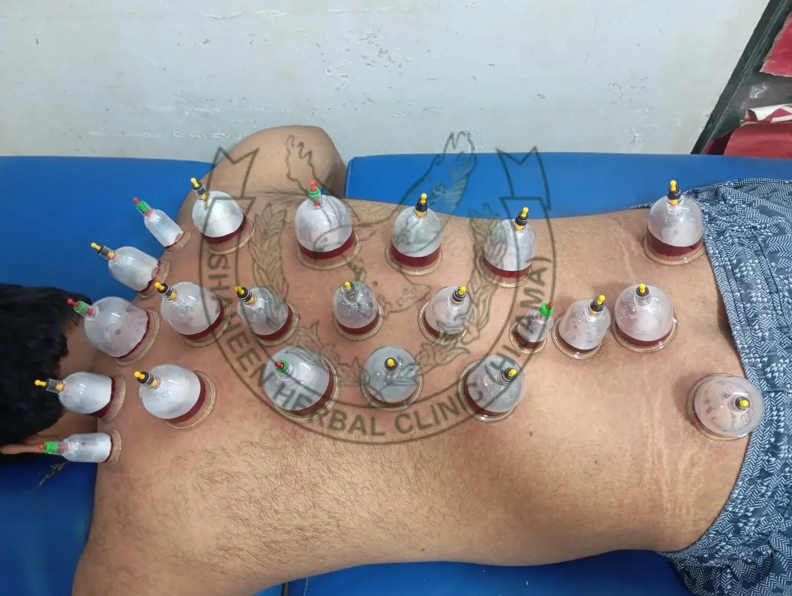 hijama medication cupping therapy