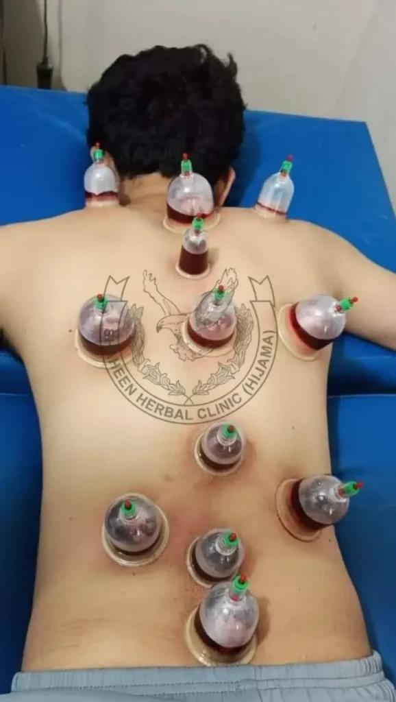 hijama therapy