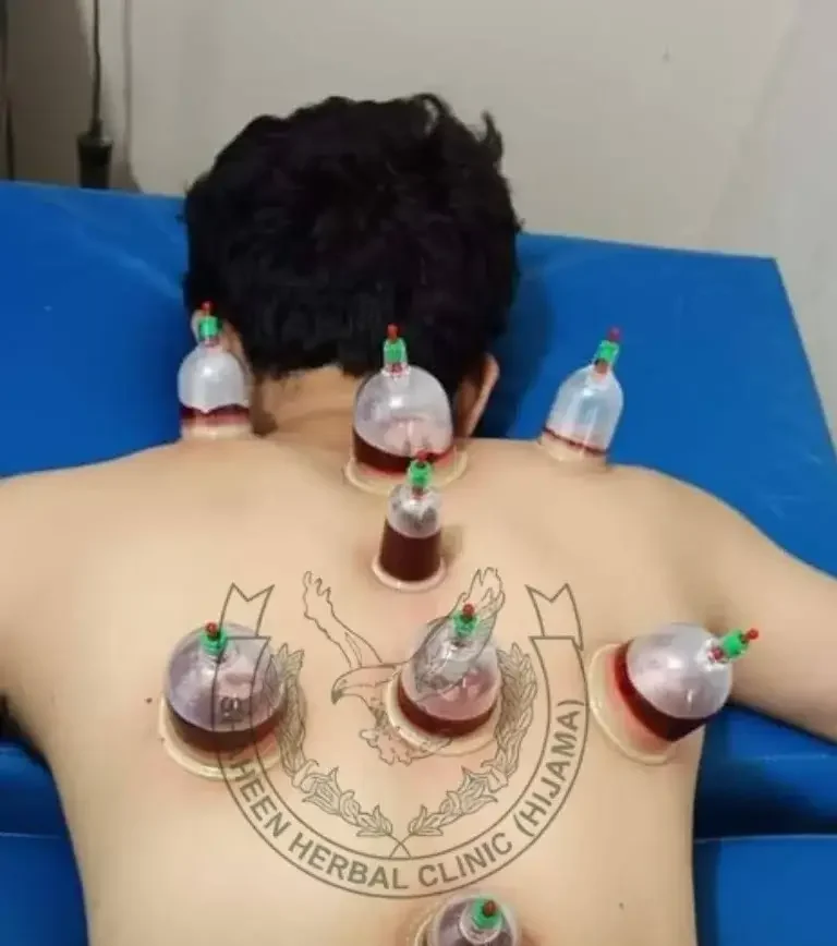 hijama therapy