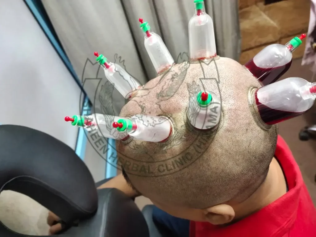 therapy hijama